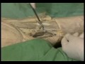Блокада запирательного нерва - анатомия и техника выполнения